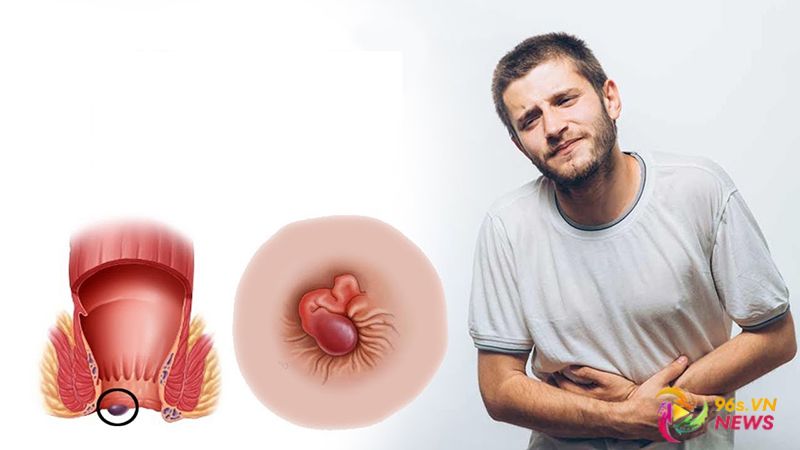 Top 10 thuốc chữa trĩ tốt nhất hiện nay