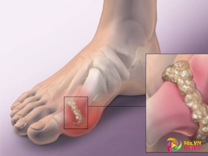 Top 5 Thuốc Điều Trị Gout Tốt Nhất Hiện Nay