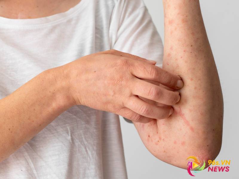 Top 10 thuốc trị viêm da cơ địa tốt nhất hiện nay