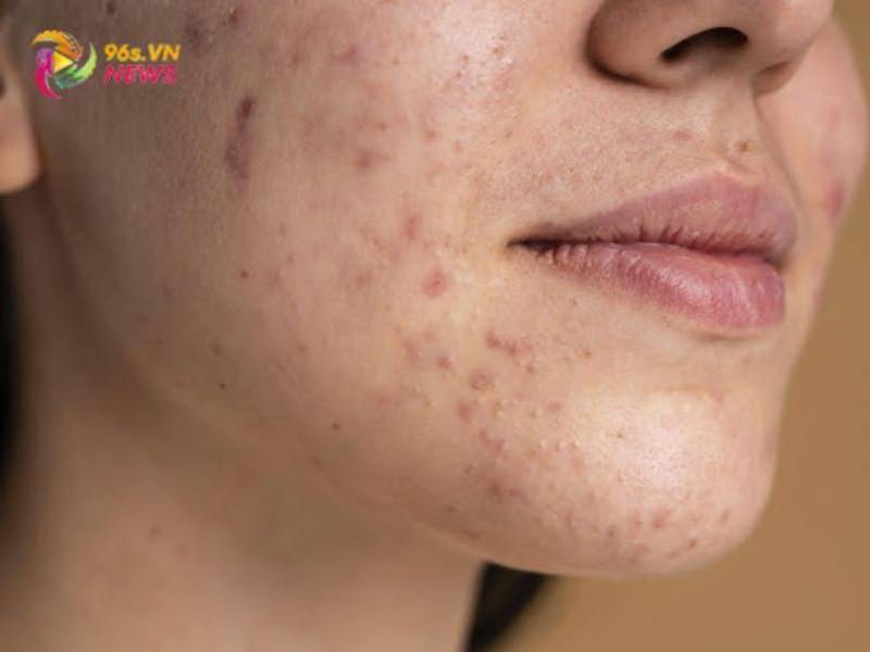 Nguyên nhân hình thành mụn thâm